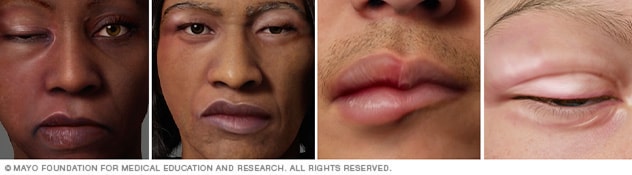 Angioedema on four different skin colors.
