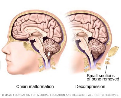 Image result for chiari decompression