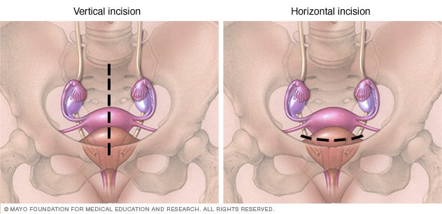 经腹子宫切除术的垂直和水平切口