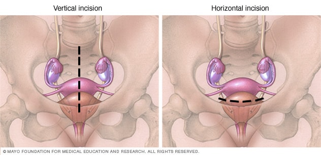 Laparoscopic oophorectomy - Mayo Clinic