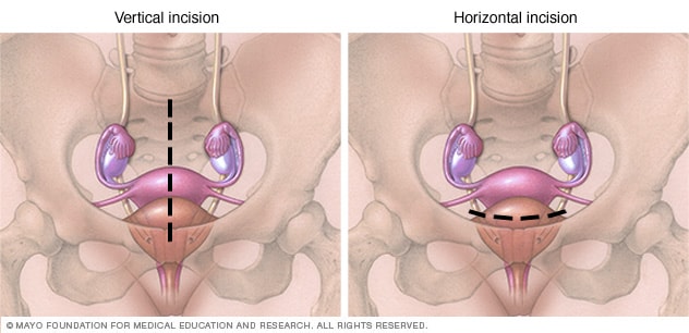 laparoscopic hysterectomy before and after