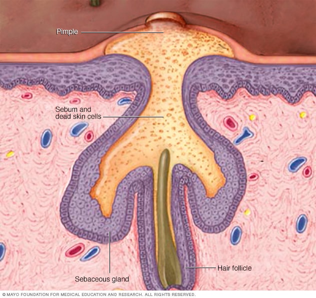 Where Do Pimples Come from: Uncover the Hidden Causes