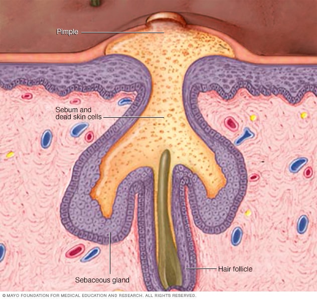 Pimple Causes Chart