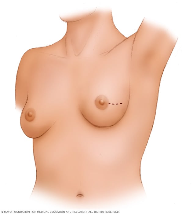 7 Things To Know About Lumpectomy After Care