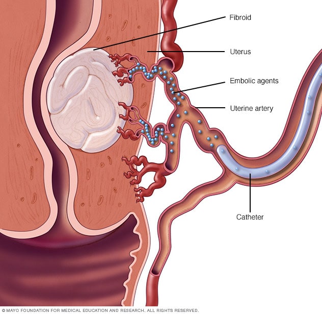 Focused ultrasound surgery for treatment of uterine fibroids