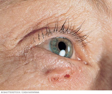 Photograph of basal cell carcinoma 