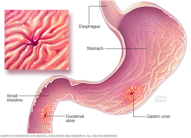 Helicobacter Pylori H Pylori Infection Symptoms And Causes Mayo Clinic