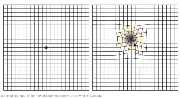 Amsler grid - Mayo Clinic