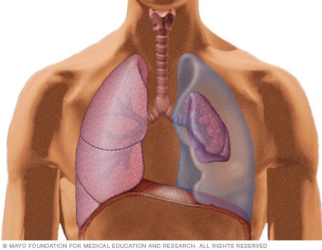 Pulmón colapsado y pulmón normal