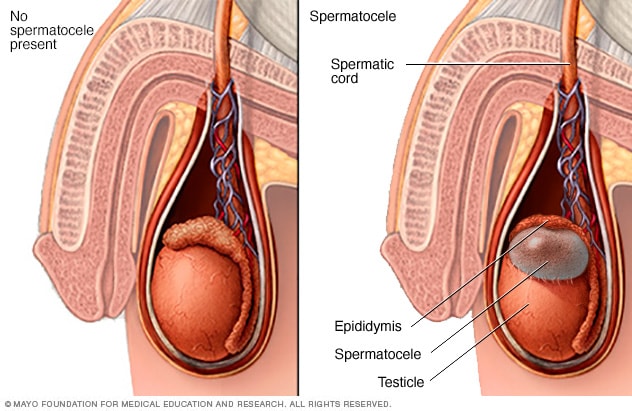 Scrotal Masses - Symptoms And Causes