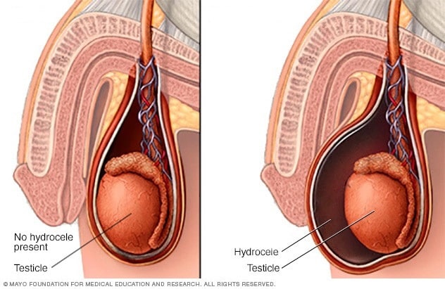 Hidrocele
Es una inflamación en el escroto ocurre cuando hay una acumulación de líquidos
