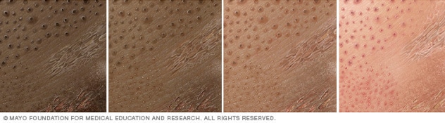 Contact dermatitis on four different skin colors.