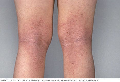 atopic dermatitis pictures on legs)