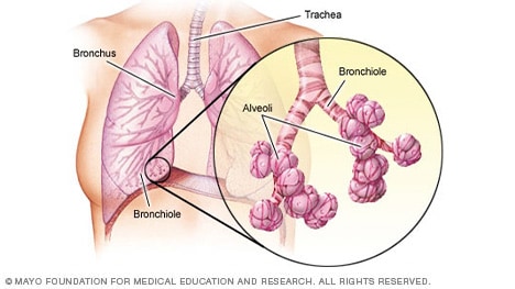 Illustration showing bronchi, bronchioles and alveoli