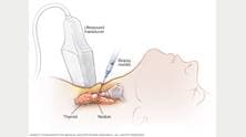 Ilustración de una biopsia por punción de cáncer de tiroides 
