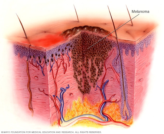 melanoma skin moles