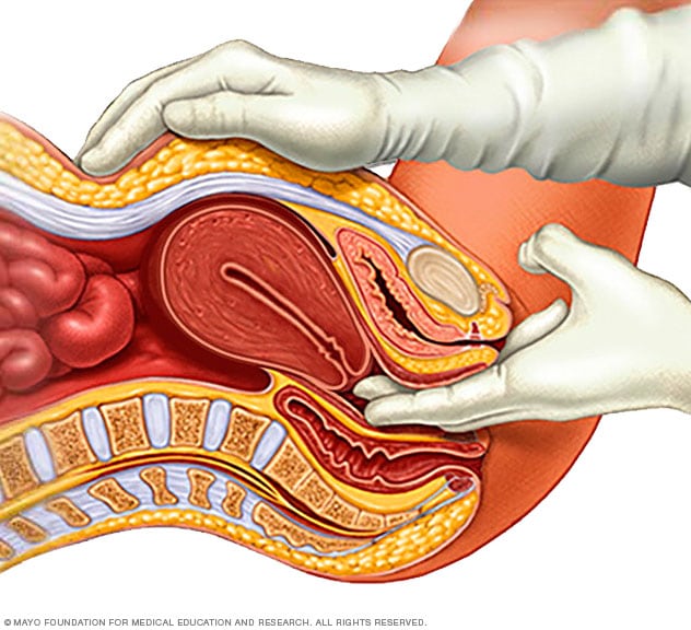 Polycystic Ovary Syndrome Pelvic Examination