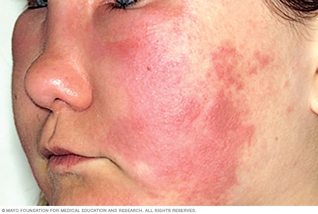 Hives And Angioedema Symptoms And Causes Mayo Clinic