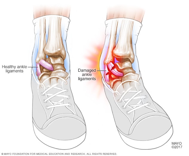 Sprained ankle - Symptoms and causes - Mayo Clinic