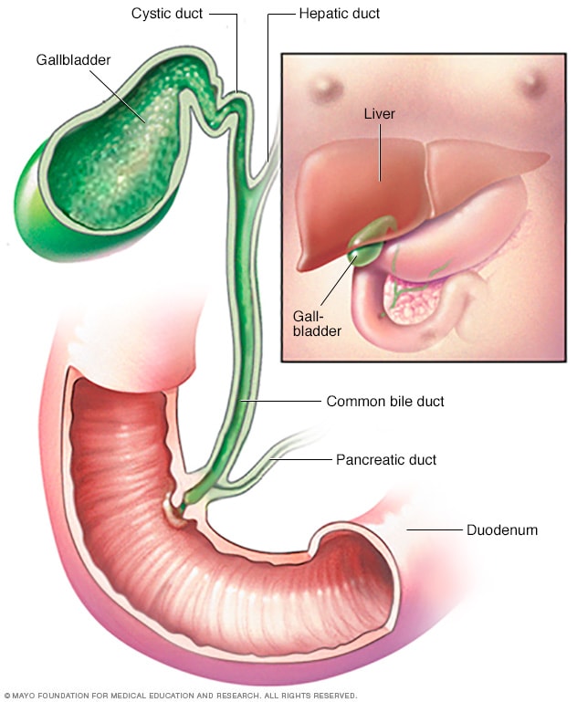 cancer vesicula biliar etapa 4)