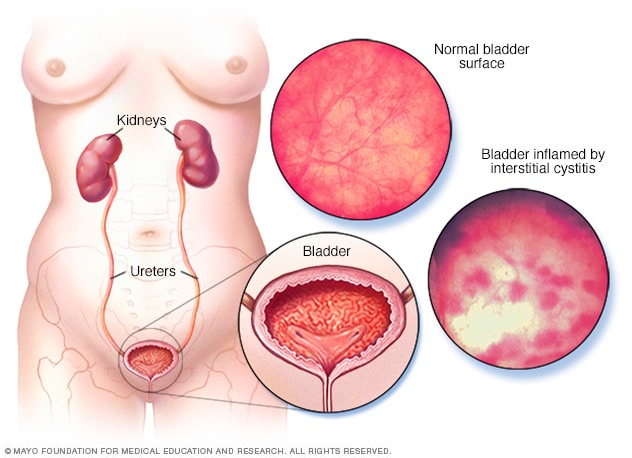 图示显示间质性膀胱炎对膀胱的影响