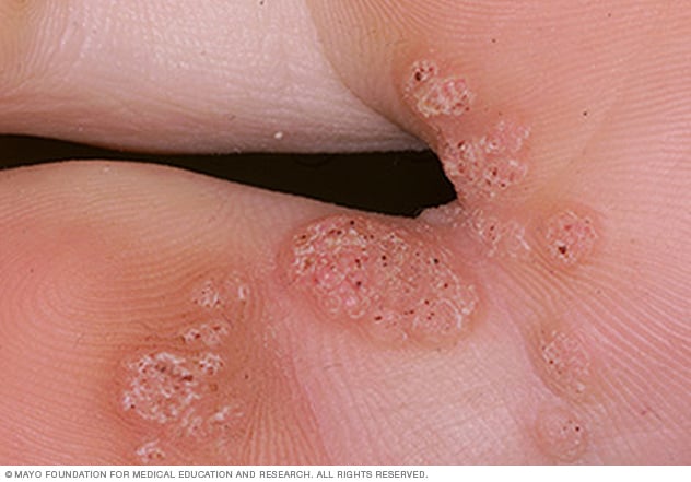 human papillomavirus skin infection