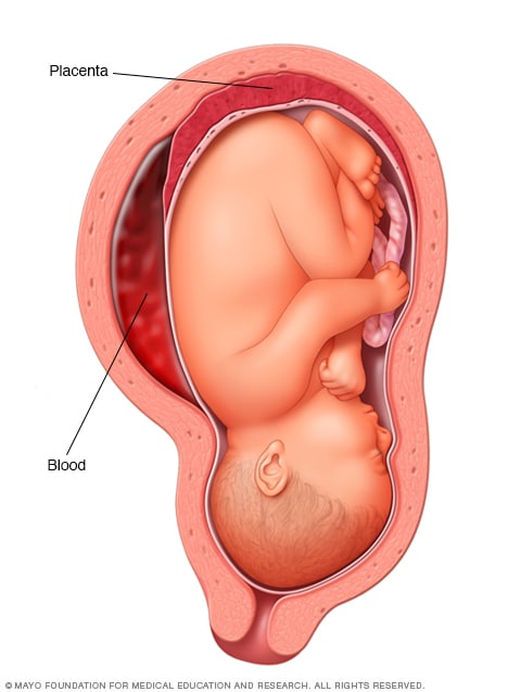 Desprendimiento de la placenta