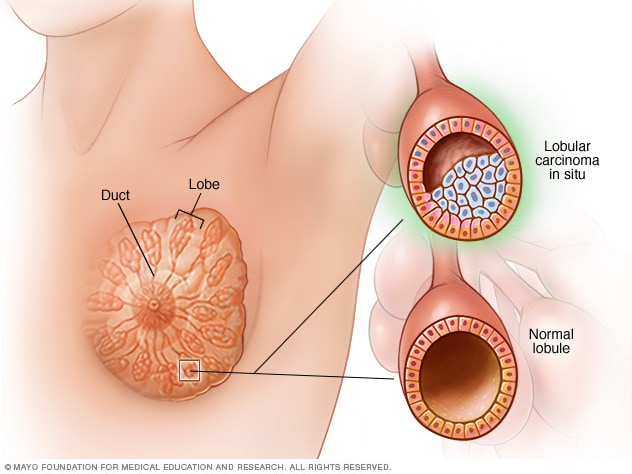 clinic breast mayo cancer dcis