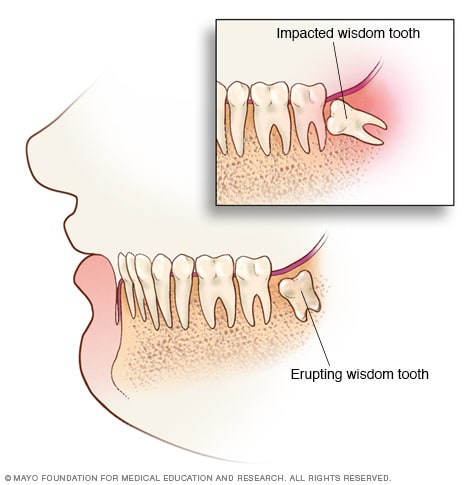Impacted wisdom teeth - Symptoms and causes - Mayo Clinic