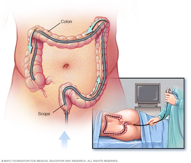 cancer la colon diagnostic