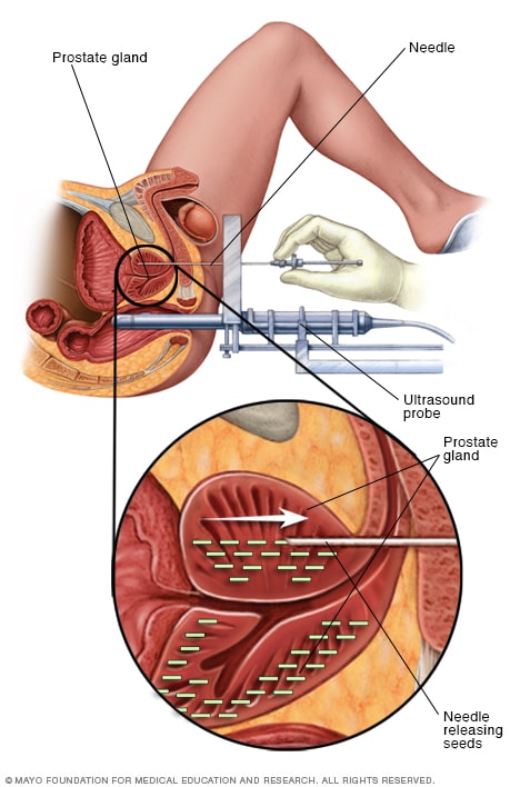 prostate calcification mayo clinic