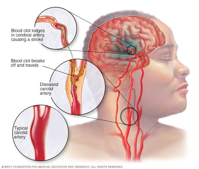 出现病变的颈动脉和脑动脉中的血凝块