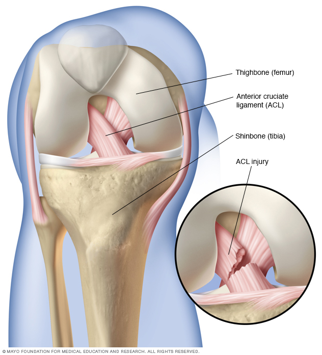 torn acl