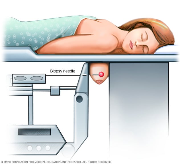 clinic breast mayo cancer dcis