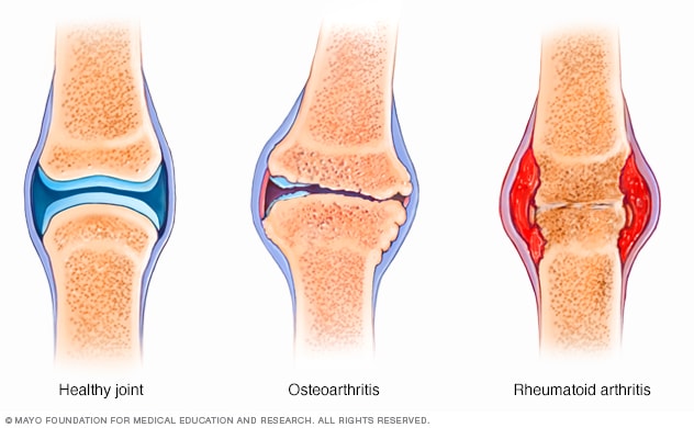 graph comparing osteoarthritis to rheumatoid arthritis