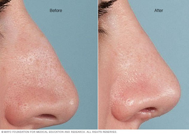 Best Rhinoplasty (Nose Surgery) Lexington, KY - Plastic Surgeons of Lexington