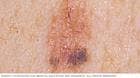 Mole that may become melanoma