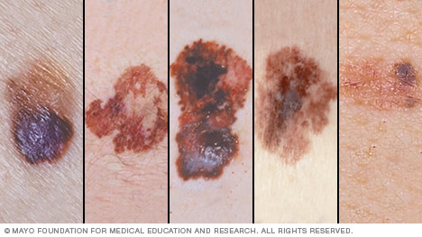 A melanoma look what like does End of