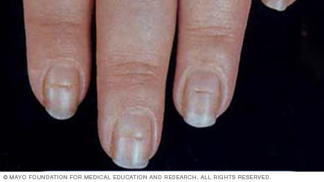 moderadamente Artístico Tomar conciencia Presentación de diapositivas: Siete problemas en las uñas que no se deben  ignorar - Mayo Clinic