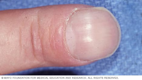 An example of fingernails with nail clubbing