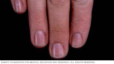 Ejemplo de uñas de las manos con hendiduras