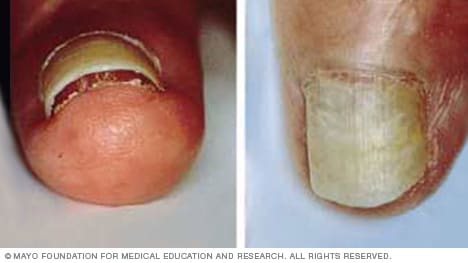 Onychomadesis (proximal nail plate separation from the nail matrix and... |  Download Scientific Diagram