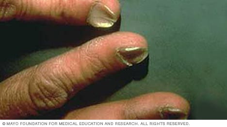 I recently noticed dents on my nails. Does that mean anything? Do I have a  disease? - Quora