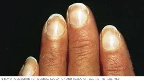 An example of fingernails with Terry's nails