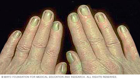 Ejemplo del síndrome de las uñas amarillas