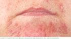 صورة فوتوغرافية لالتهاب الجلد حول الفم