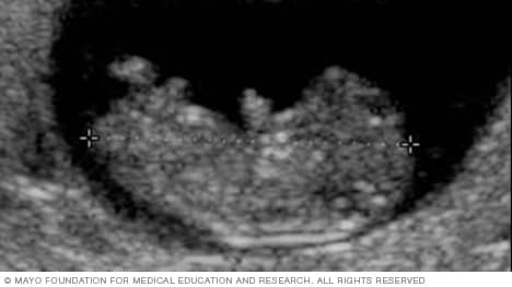 التصوير بالموجات فوق الصوتية للبطن يبين الشكل الجانبي لجنين في الشهر الـ 11