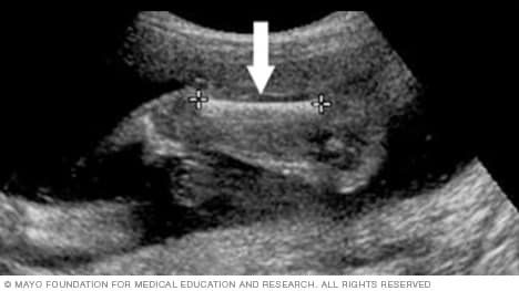 Fetal ultrasound slide showing the length of baby's femur