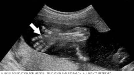 Imagen de ecografía fetal que muestra una mano y los dedos abiertos
