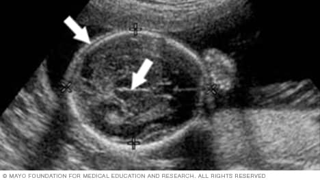 Ultrasound showing a fetus' head